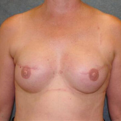 Breast Cancer Reconstruction Before and After