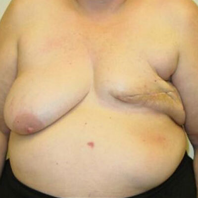 DIEP Flap Reconstruction Before and After