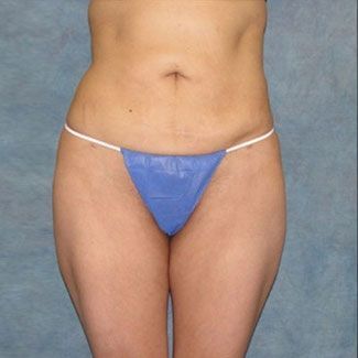 Northern VA Liposuction after