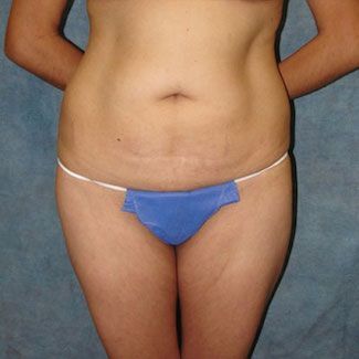 Northern VA Liposuction before