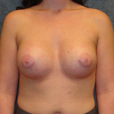 Tuberous breast Correction before and after