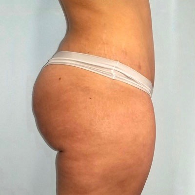 Brazilian Butt Lift Before And After Patient 2