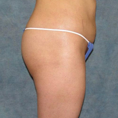 Fat Transfer Before & After Image
