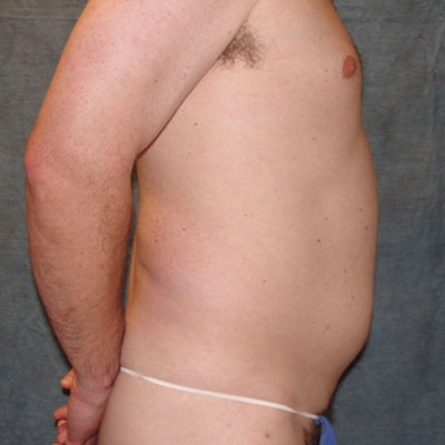 Liposuction for Men Before Photo
