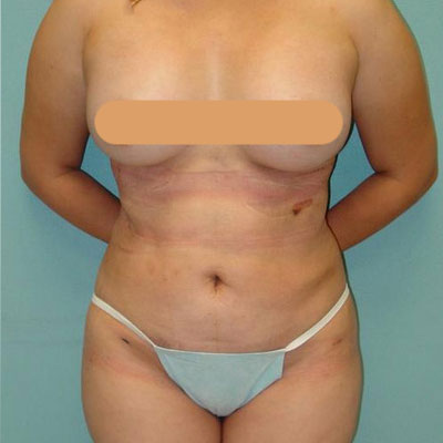 Liposuction Before and Afters patient 2