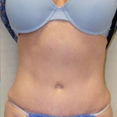 Liposuction Before and Afters patient 7