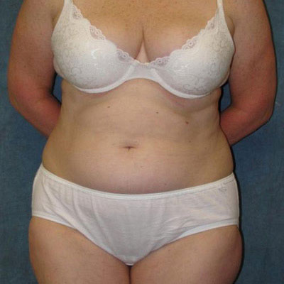 Liposuction Before Photo