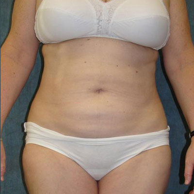 Liposuction Before and Afters patient 9