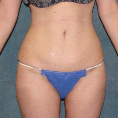 Liposuction Before and Afters patient 10
