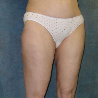 Liposuction Before and Afters patient 13