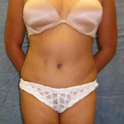 Liposuction After Photo