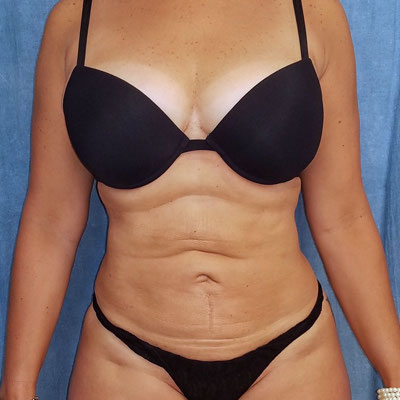 Liposuction Before and Afters patient 17