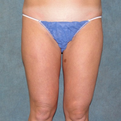 Liposuction Before and Afters patient 18