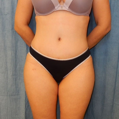 Liposuction on thighs Before and Afters patient 19