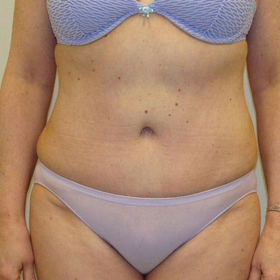 Tummy Tuck Before and After Patient 3