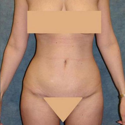 Tummy Tuck Before and After Patient 6
