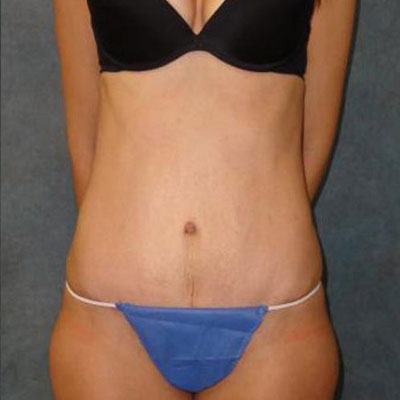 Tummy Tuck Before and After Patient 8