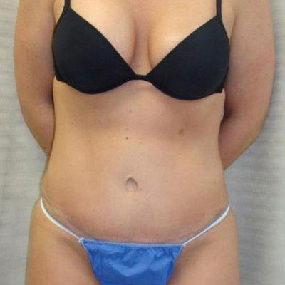 Tummy Tuck Before and After Patient 9