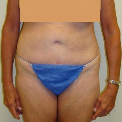 Tummy Tuck Before and After Patient 10