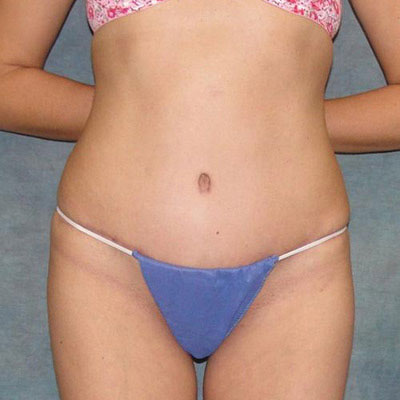 Tummy Tuck Before and After Patient 11