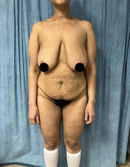 Tummy Tuck Before & After Image