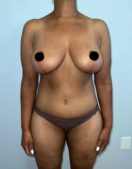 Tummy Tuck Before & After Image