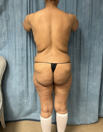 Tummy Tuck Before & After Image