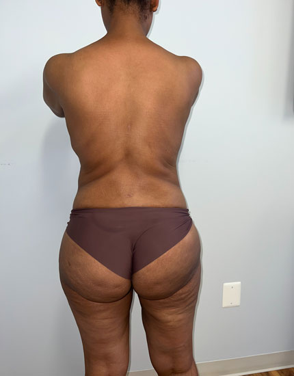Tummy Tuck Before & After Image