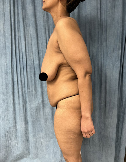Tummy Tuck Before & After Image