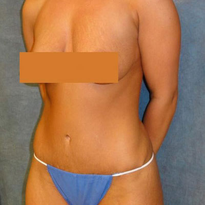 Tummy Tuck Before and After Patient 12