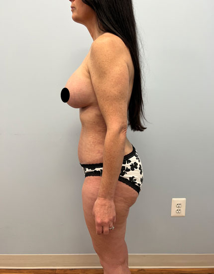 Tummy Tuck Before & After Image