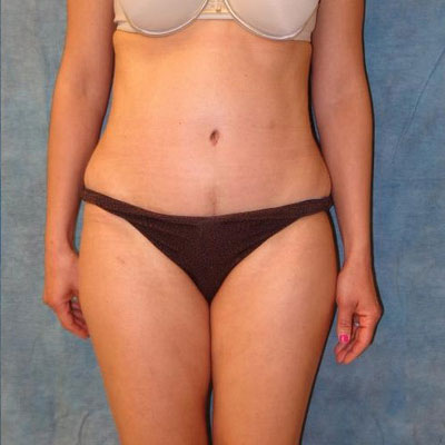 Tummy Tuck Before and After Patient 14