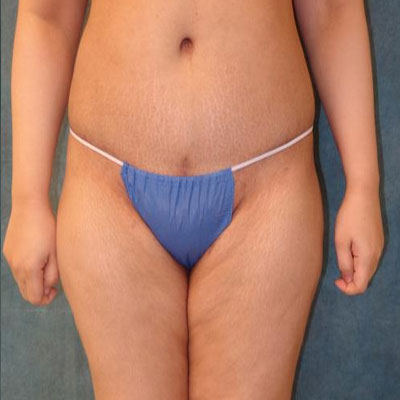 Tummy Tuck Before and After Patient 18
