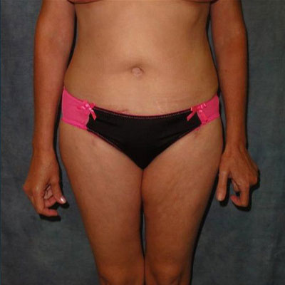 Tummy Tuck After Photo