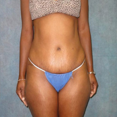 Tummy Tuck Before and After Patient 26