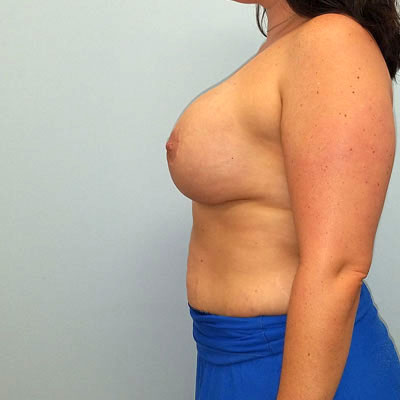 Breast Augmentation & Lift After Photo