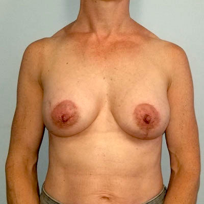 Breast Augmentation & Lift Before & After Image