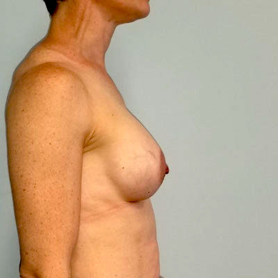 Breast Augmentation & Lift Before & After Image