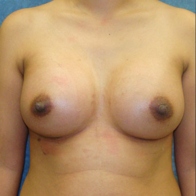 Breast Augmentation Before And After Patient 9