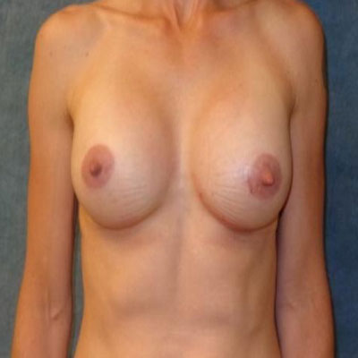 Breast Augmentation Before And After Patient 18
