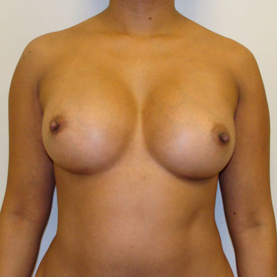 Breast Augmentation Before And After Patient 20