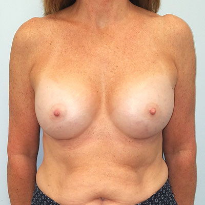 Breast Augmentation Before And After Patient 25