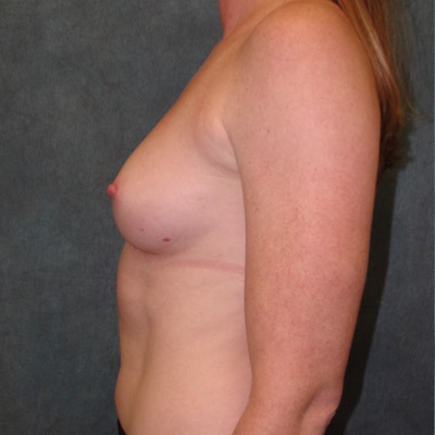 Breast Augmentation Before Photo