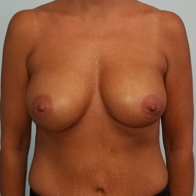 Breast Implant Replacement After Photo