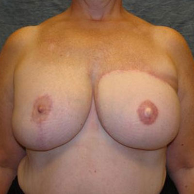 Breast Reconstruction Flap Before & After Image
