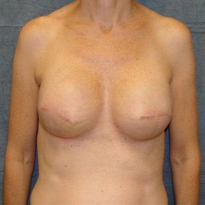 Breast Reconstruction Before and After Patient 2