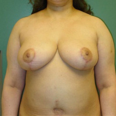 Breast Reduction before and after patient 1