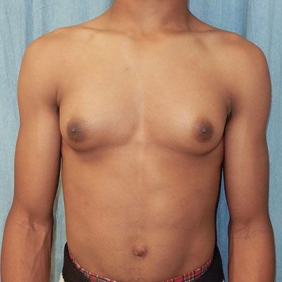 Male Breast Reduction | Gynecomastia Before & After Image