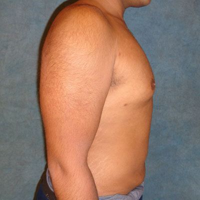 Male Breast Reduction After Photo