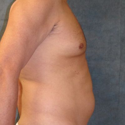 Male Breast Reduction Before Photo